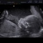 Фотографии УЗИ на 23-й неделе беременности