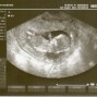 Фотографии УЗИ на 13-й неделе беременности
