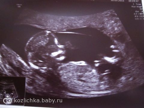 Как выглядит узи на 12 неделе