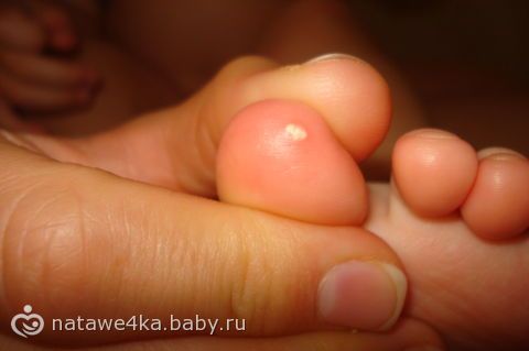 то, что на стопе болит точка белая присоединяюсь